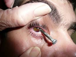Image result for OCULAR TRAUMA IMAGE