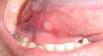 Tongue canker sores pictures