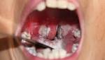 ارتفاع الإصابات بمرض الدفتيريا في