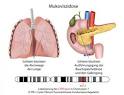 Mukoviszidose - Zystische Fibrose: Welche Organe sind von der