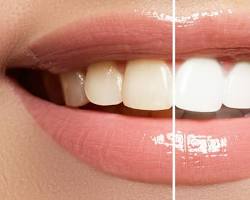 Image of Teeth Whitening