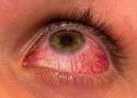 Herpes am auge was tun