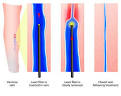 Ablation des varices