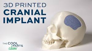 💀 Cranial Implant 3D Printed From Hydroxyapatite Ceramic In ...