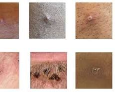 Imagem de Mpox pustules