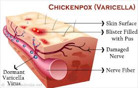 Image result for chicken pox