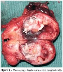 Image result for teratoma