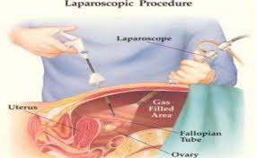 Image result for laparoscopy for ectopic pregnancy