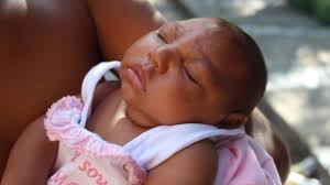 Image result for pictures of zika babies