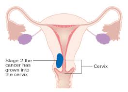 Image result for Uterine cancer