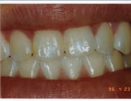 Image result for fluorosis