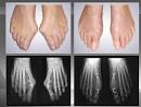 Hallux valgus AFCP Association Franaise de Chirurgie du Pied