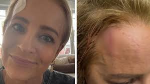Carrie Bickmore gives shocking update after horrific face injury