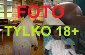 Znalezione obrazy dla zapytania Cysta