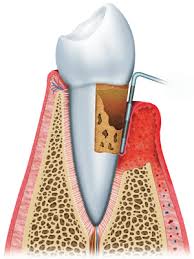 Resultado de imagen para cemento radicular dental