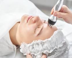 Image of Radiofrequency treatment