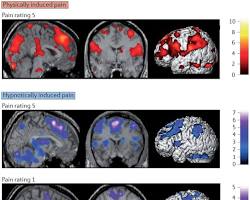 Imagen de Brain activity during placebo effect