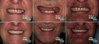 ... start today! You pick the style and shade of your new smile. Your dentist takes an impression of your teeth. You come back in about three weeks for a ... - snap-on-smile-before-after