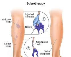 Image of Sclerotherapy for varicose veins