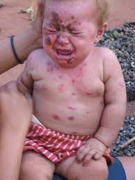 Resultado de imagen para daño del glifosato a la población indigena colombiana amazonica