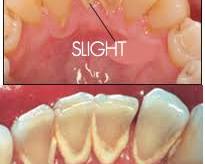 Image of plaque buildup on teeth