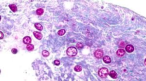 Cases of ‘explosive diarrhea' infections spread in U.S., with major Midwest outbreak