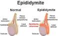 Pididymite - - Forum