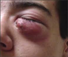 Résultat de recherche d'images pour "eye infection"