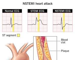 Image of NSTEMI Heart Attack