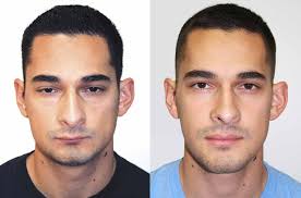 Image result for jaw surgery