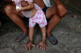 Image result for ‫دختر بچه ای با پاهای گنده‬‎