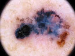 Melanoma