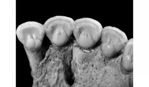 Résultat de recherche d'images pour "shovel shaped incisors"