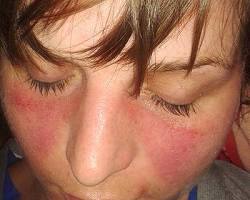 Image of Person with lupus butterfly rash on their face
