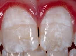 Image result for fluorosis