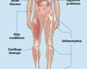 Image of Rheumatoid arthritis in joints