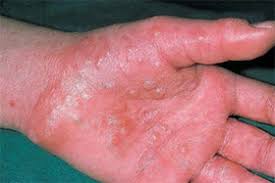 Hasil gambar untuk Dyshidrotic Eczema