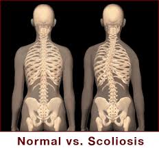 tulang belakang normal versi scoliosis