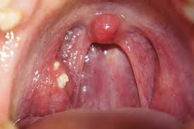 Image result for tonsil stones