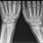 FDA Approves AI Algorithm To Help Doctors Diagnose Fractures Faster