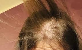 أزمة شعر رحمة حسن تتفاقم بسبب خطأ طبي.. هل تتحول لعاهة مستديمة؟