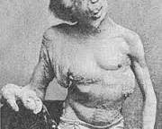 Joseph Merrick, Elephant Man