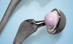 Hip Replacement Surgery - Schroeder Ambulatory Centre