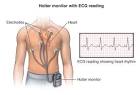 Holter Monitor Johns Hopkins Medicine Health Library