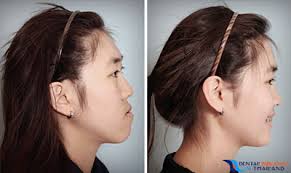 Image result for jaw surgery