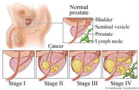 Image result for kanker