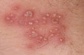http://ginekologi.org/chlamydia