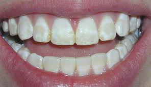 Image result for fluorosis