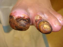 Image result for diabetes
