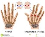 Rheumatic Diseases: Types, Causes, and Diagnosis - WebMD